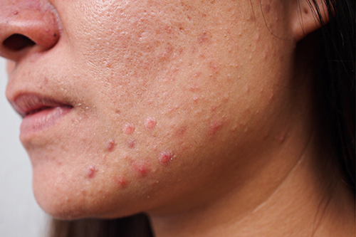 Acne / Skin conditions